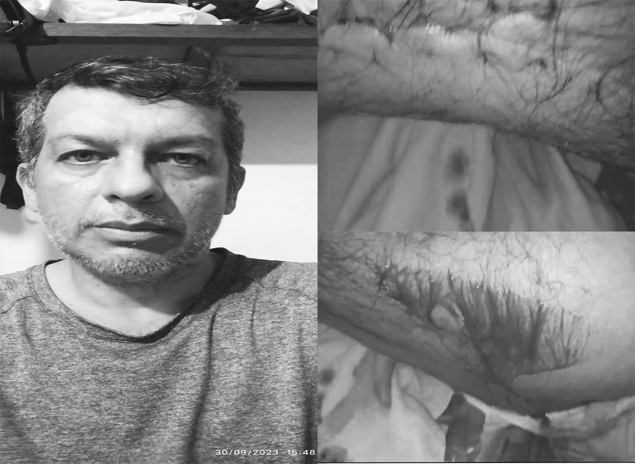 Presunta negligencia médica podría dejar a un hombre sin su pierna