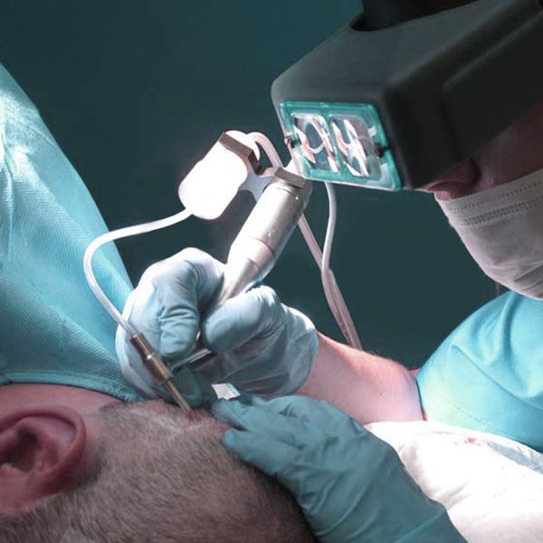 Implante capilar después de un tratamiento de cáncer