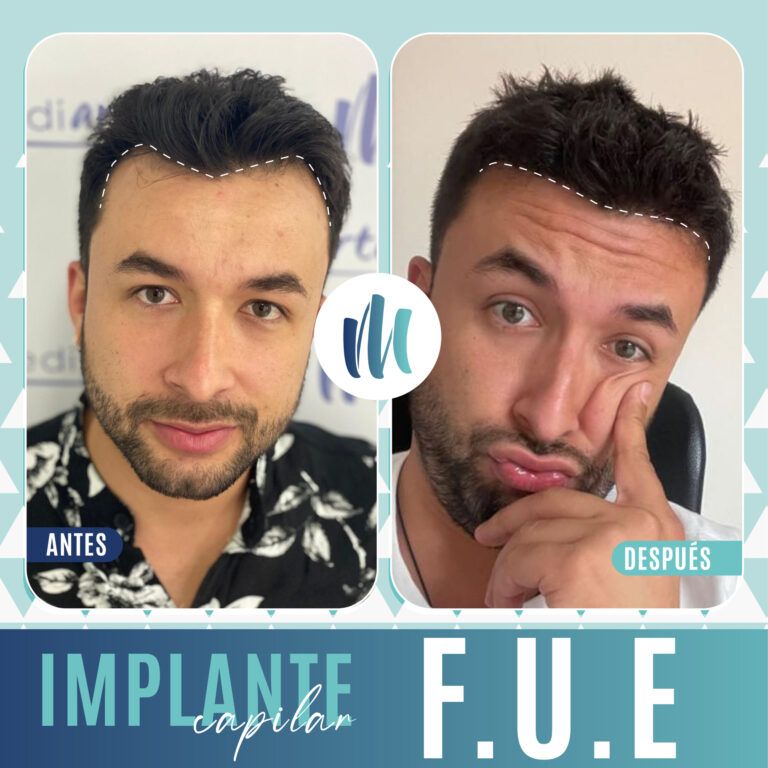 Los primeros días después del trasplante de cabello