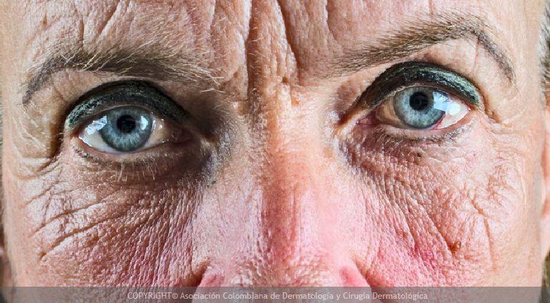 ¿Cómo se forman las arrugas?