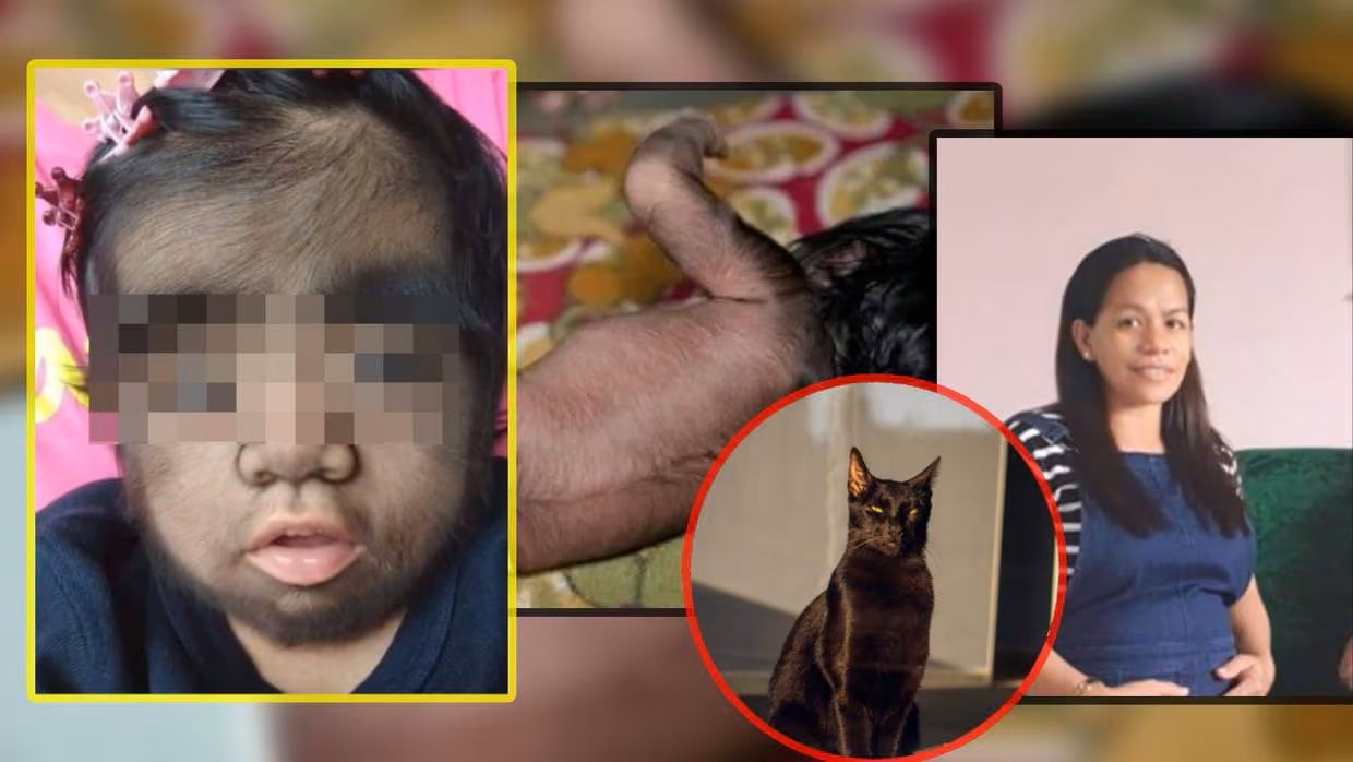 Madre da a luz a bebé lleno de pelo y culpa a una maldición por comer carne de gato