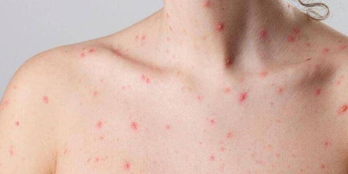 Barrancabermeja refuerza medidas contra la viruela del mono