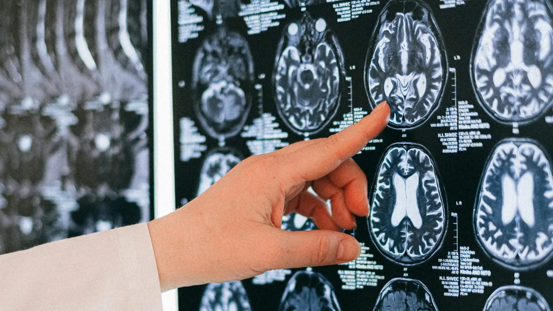 Un hallazgo preocupante de microplásticos en el cerebro humano