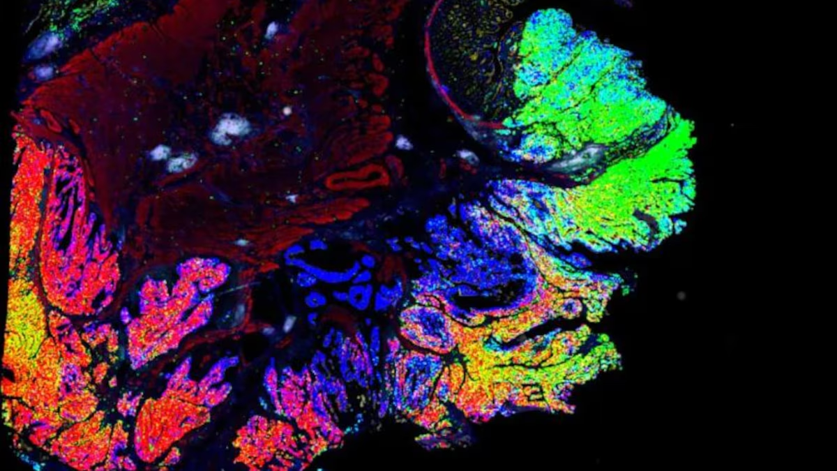 Avances en el tratamiento del cáncer con mapas 3D de tumores