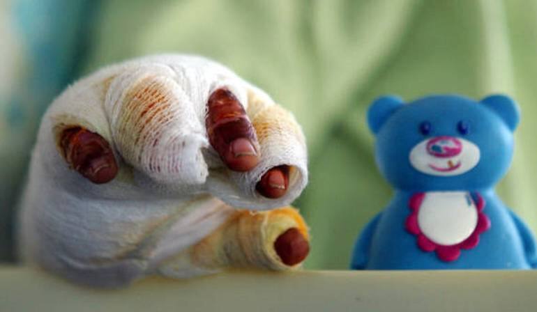 Millonaria multa a madre de menor quemado con pólvora