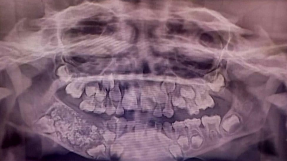 ¡Insólito! Niño fue operado para extraerle 526 dientes