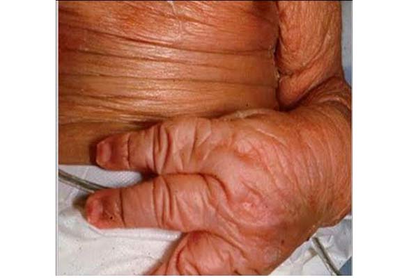 Gobierno reporta disminución de mortalidad en personas con Enfermedades Huérfanas