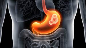 No subestime el dolor de estómago: podría ser cáncer gástrico