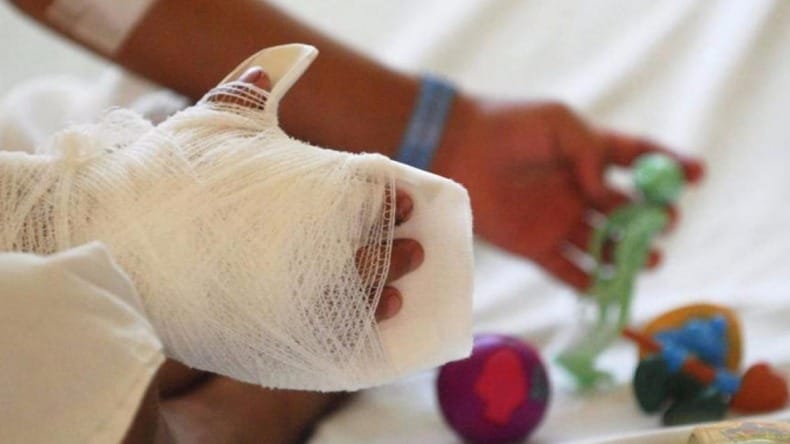 Lo que nadie cuenta sobre las quemaduras con pólvora