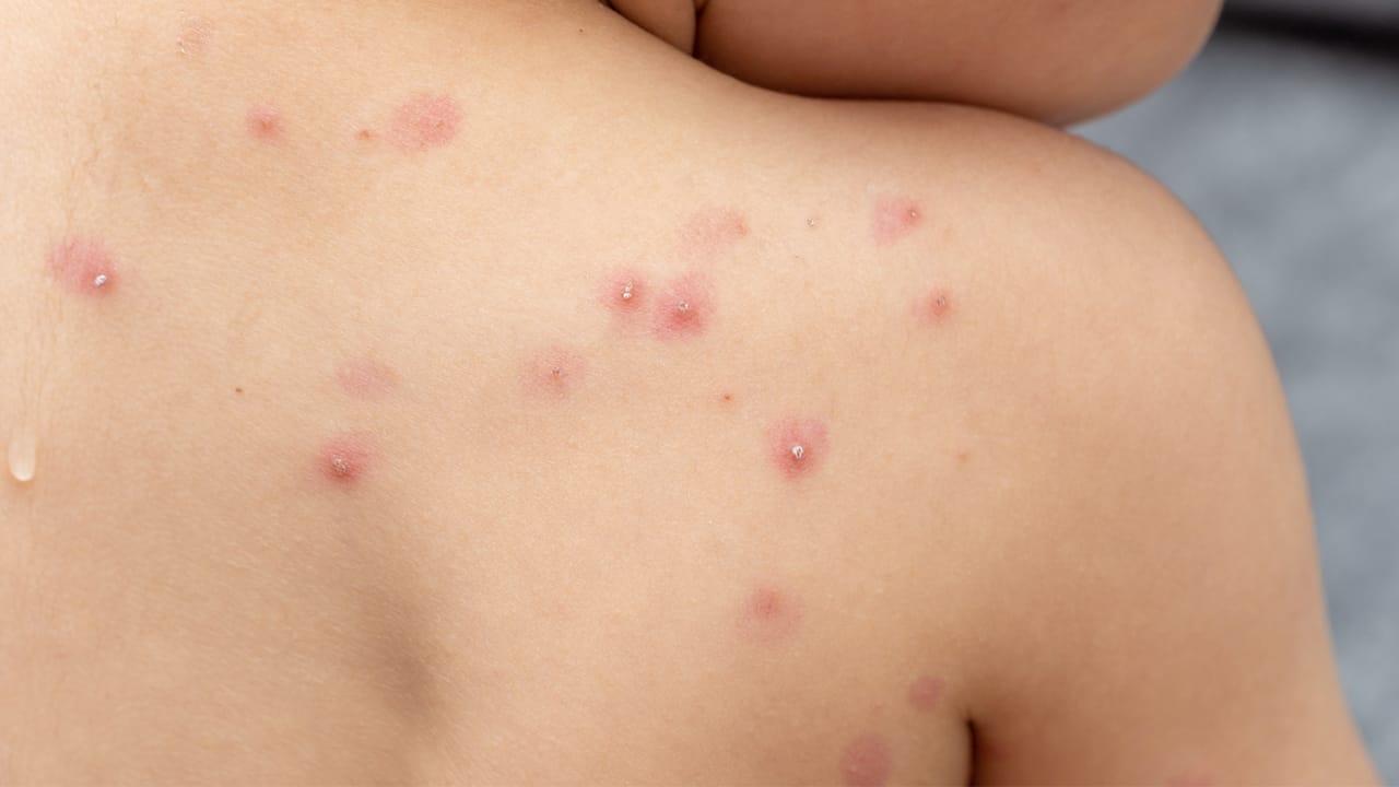 Viruela símica mantiene bajo alerta al sistema de salud de Santander