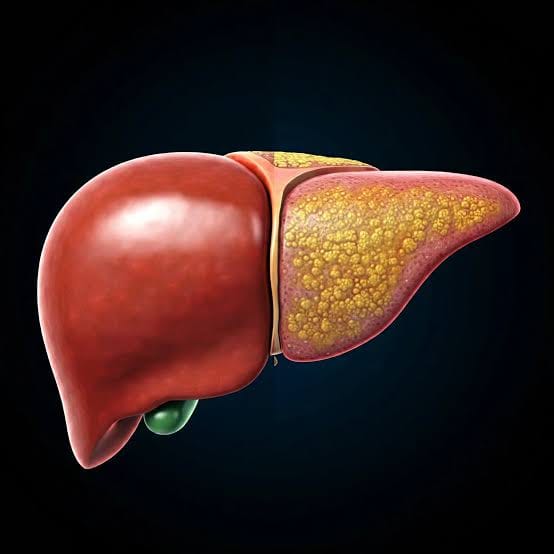 Más de 7 millones de colombianos podrían padecer hígado graso asociado a disfunción metabólica
