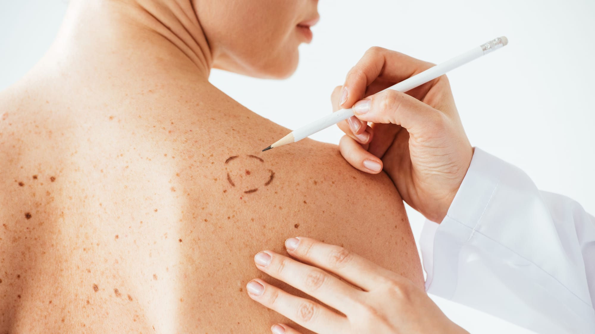 El cáncer de piel causa estragos en Bucaramanga