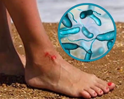 Alertan a bañistas de bacteria carnívora en aguas costeras