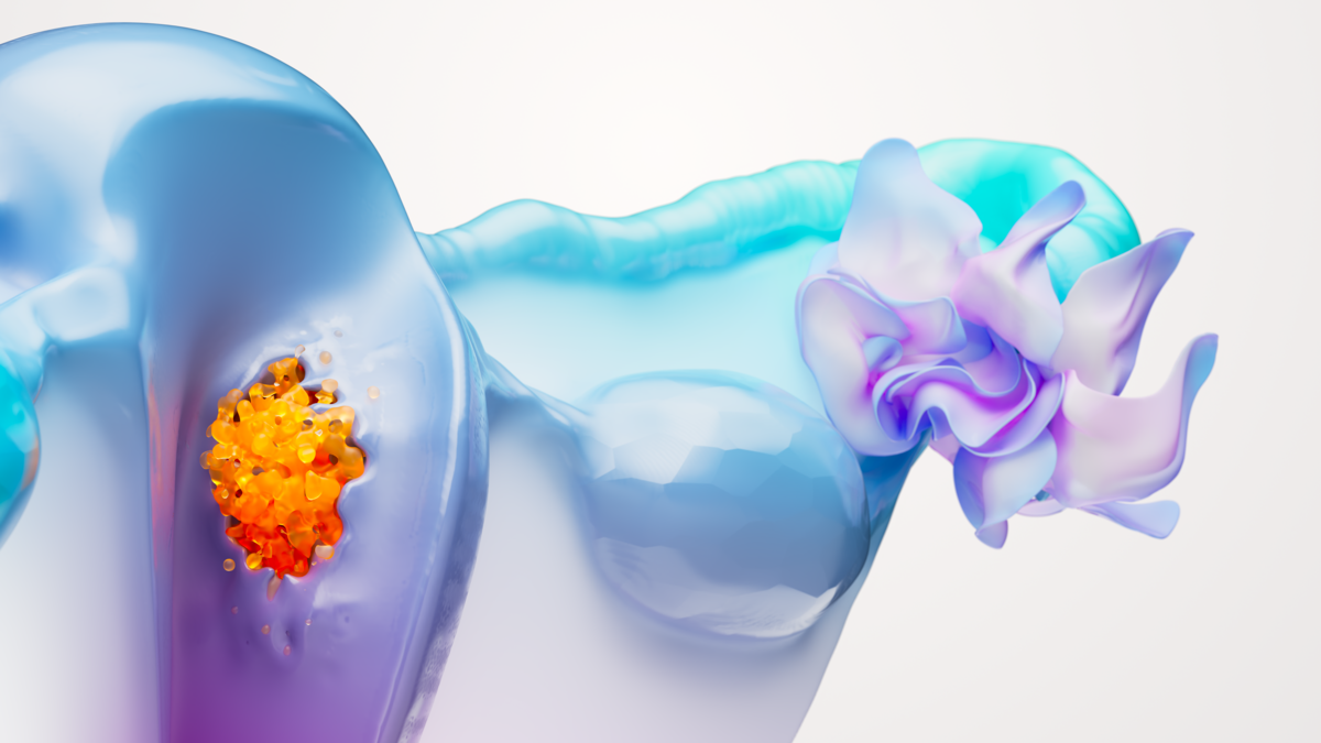 Cáncer de endometrio el segundo más  frecuente entre cánceres ginecológicos
