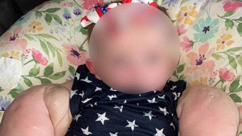Recién Nacida  Apodada "Baby Hulk" Debido a Rara Condición imagen de la publicación