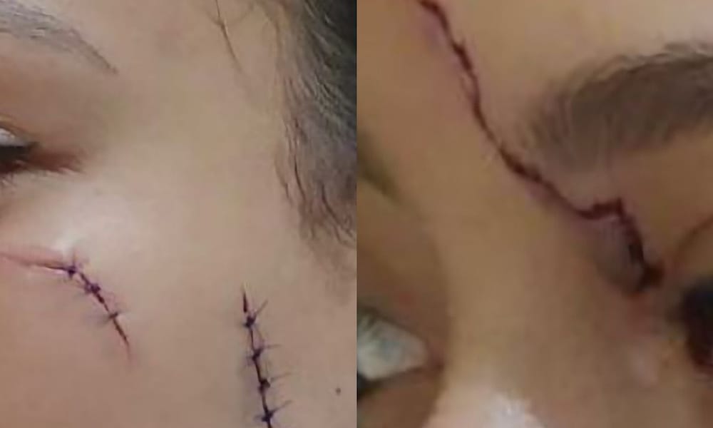 Intolerantes borrachos apuñalan a joven en la cara mientras este intentaba evitar una pelea imagen de la publicación