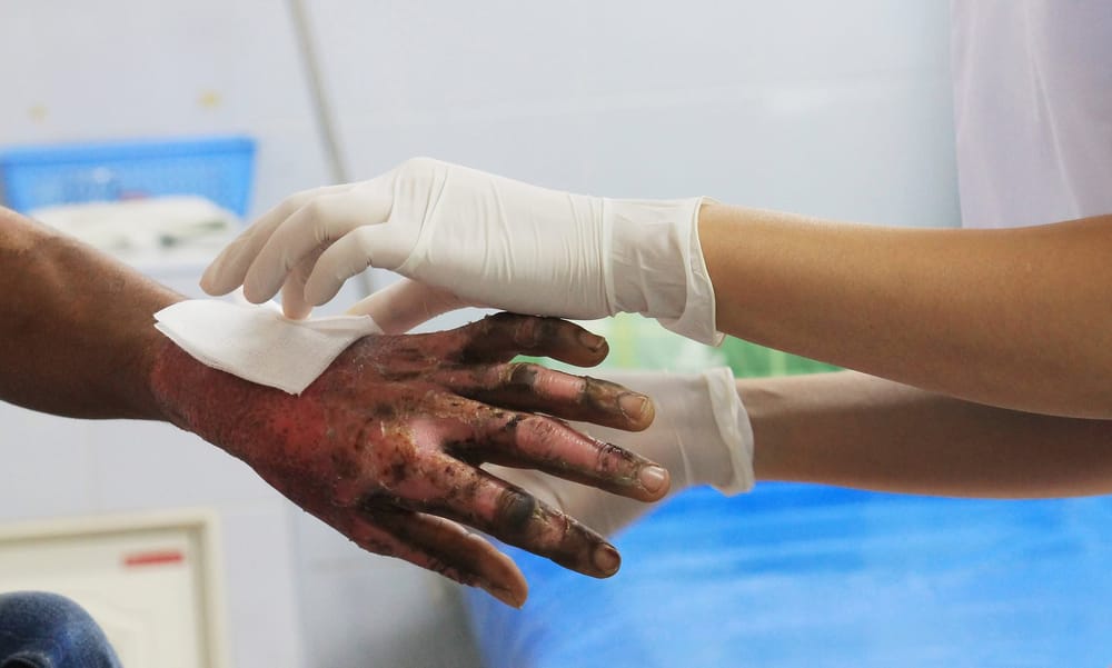 Cifra de quemados en Santander aumenta a 21 en tres días imagen de la publicación