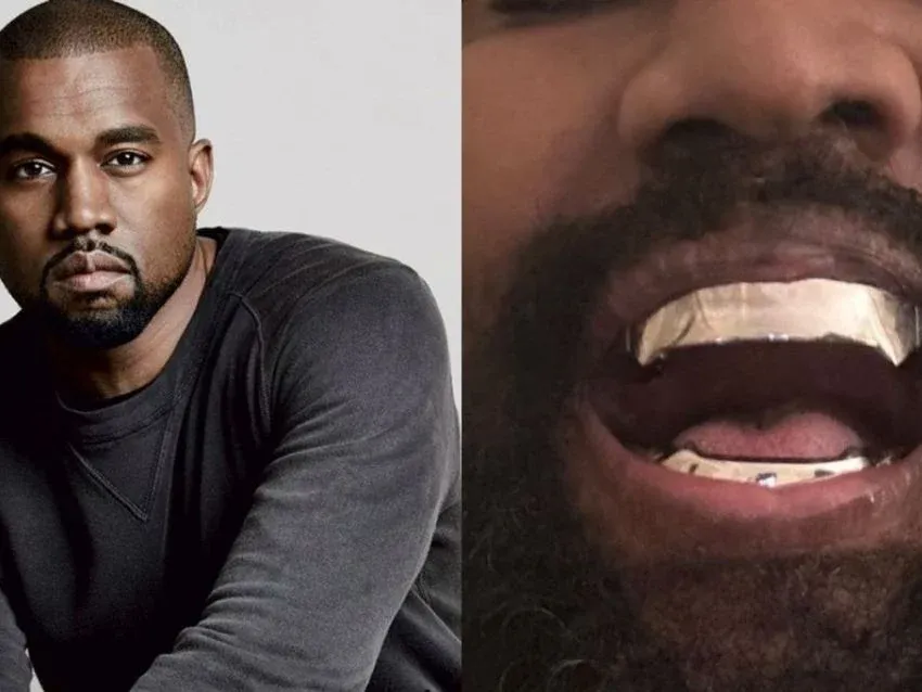 Kanye West  se implantó casi un millón de dólares en los dientes imagen de la publicación