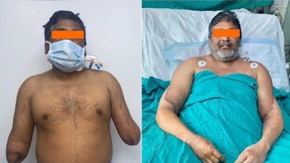 Pintor recibe trasplante de manos tras trágico accidente imagen de la publicación