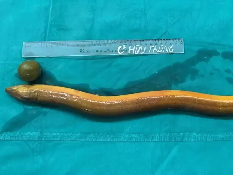 Cirugía extrema tras meterse una anguila viva en el trasero imagen de la publicación