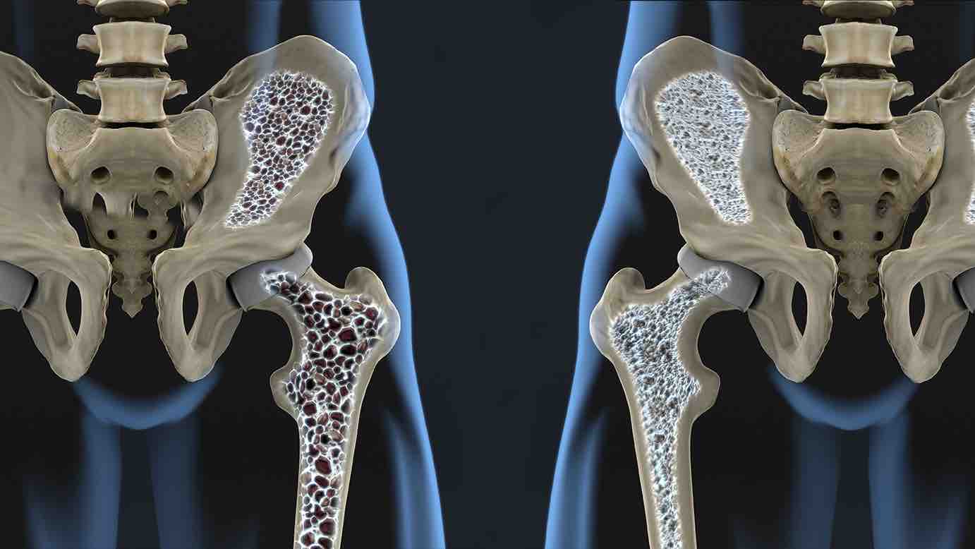 Premian al SES Hospital Universitario de Caldas por excepcional manejo de la osteoporosis imagen de la publicación