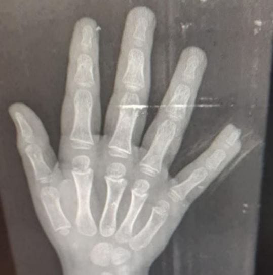 Niño de 4 años terminó con un dedo amputado en San Gil imagen de la publicación