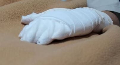 Par de quemados dejó explosión de cilindro de gas en Floridablanca imagen de la publicación