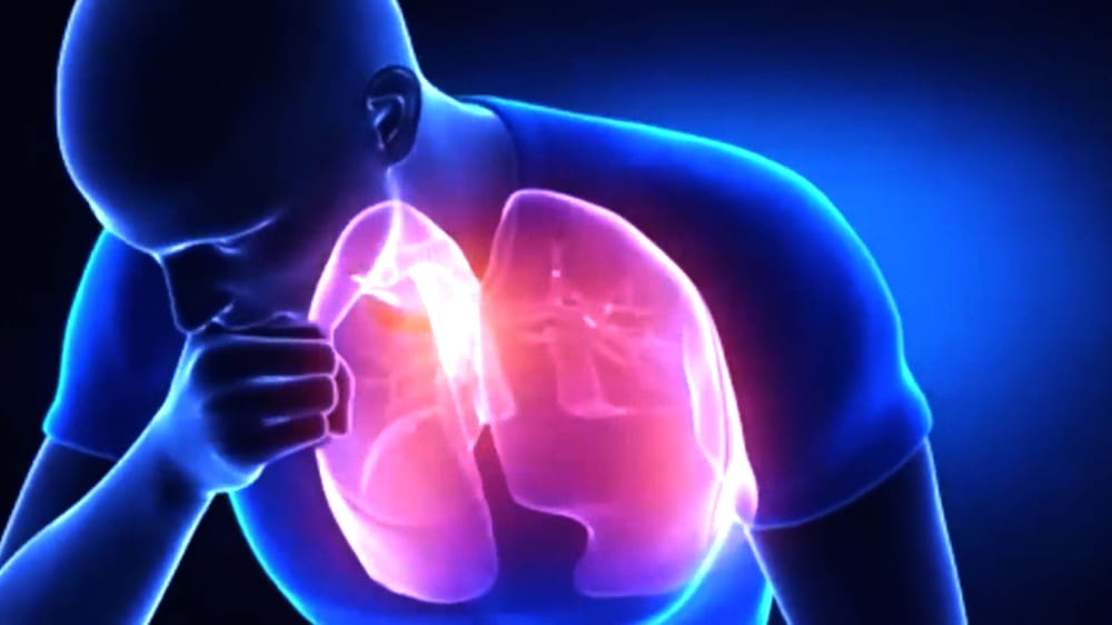 La tuberculosis vuelve a superar al COVID-19 en mortalidad global imagen de la publicación