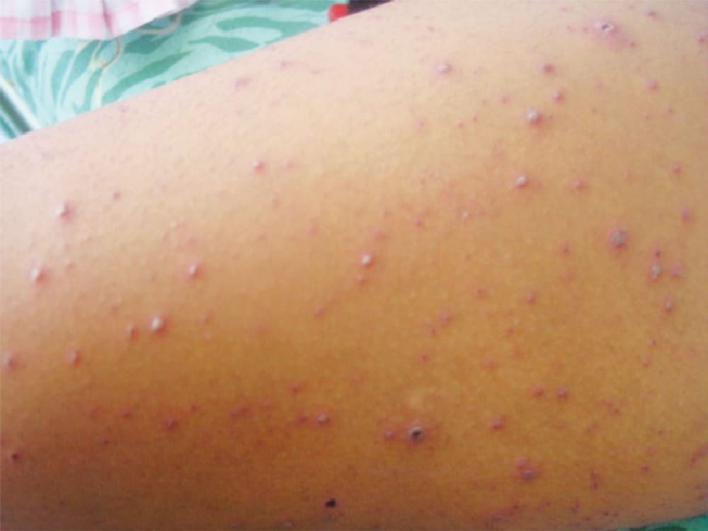 Alerta en Bucaramanga por presencia de brote de varicela imagen de la publicación