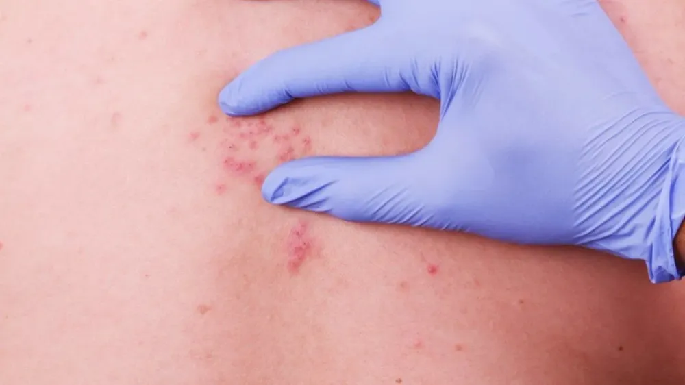 Estación de Policía  Hospital Psiquiátrico en alerta por brotes de varicela imagen de la publicación