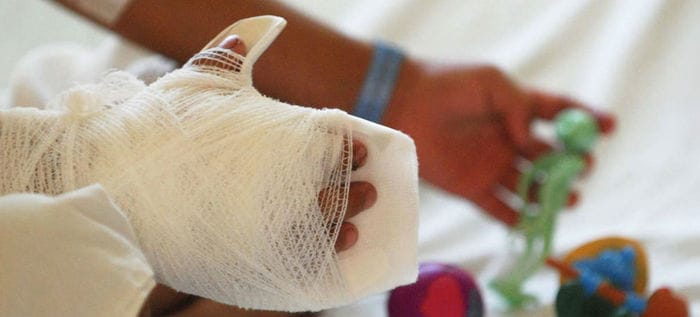 731 personas quemadas por pólvora en Colombia imagen de la publicación