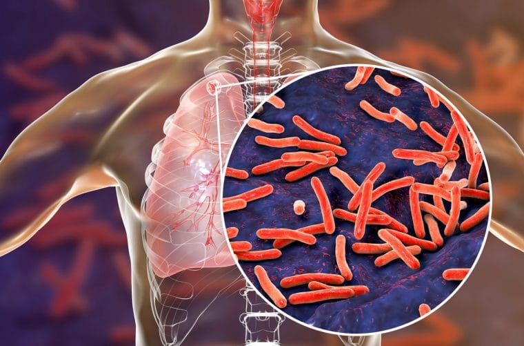 Tuberculosis en aumento: Santander registra más casos imagen de la publicación