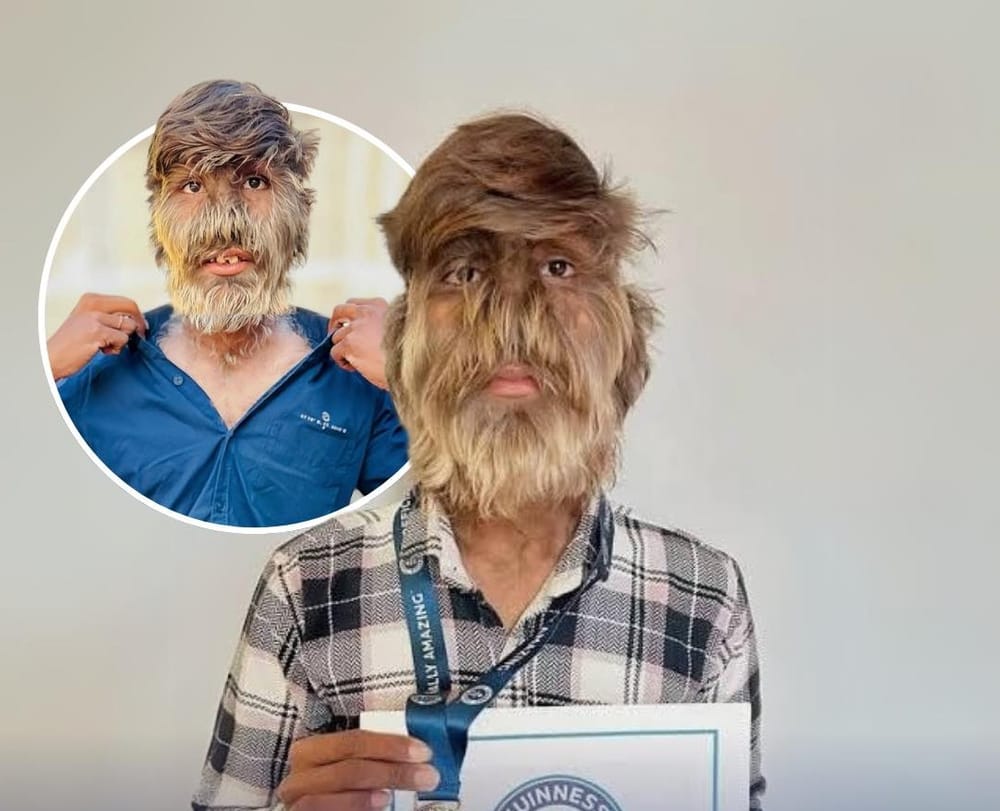 Tiene un 95% de su rostro con vello imagen de la publicación