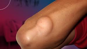 Médicos colombianos buscan visibilizar el Sarcoma de Tejidos Blandos imagen de la publicación