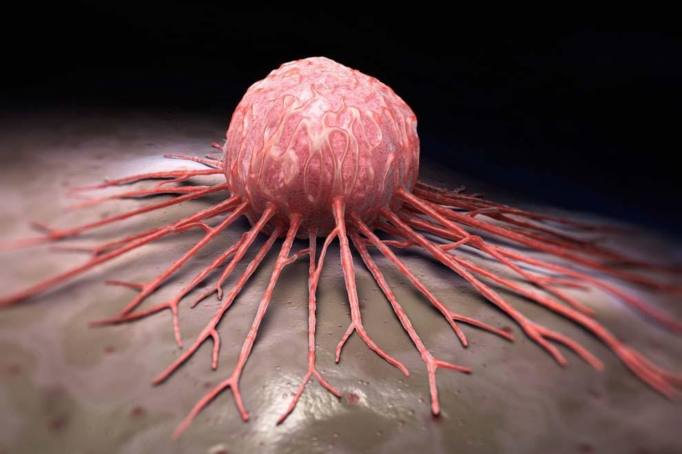 Día mundial del Mieloma Múltiple: Colombia es el tercer país en Latinoamérica con más pacientes diagnosticados imagen de la publicación