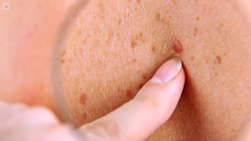 ¡Atención Bucaramanga! el Tour Salva Tu Piel llega con la jornada de chequeos de lunares más grande del país imagen de la publicación