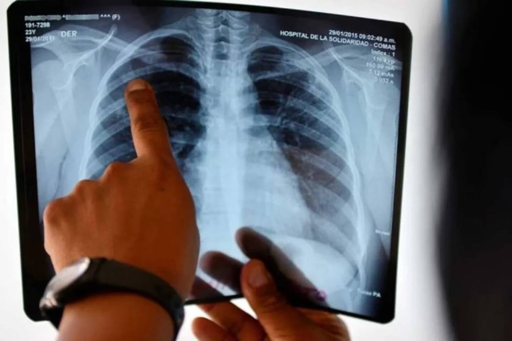 Floridablanca es cuarto en casos de tuberculosis en Santander imagen de la publicación