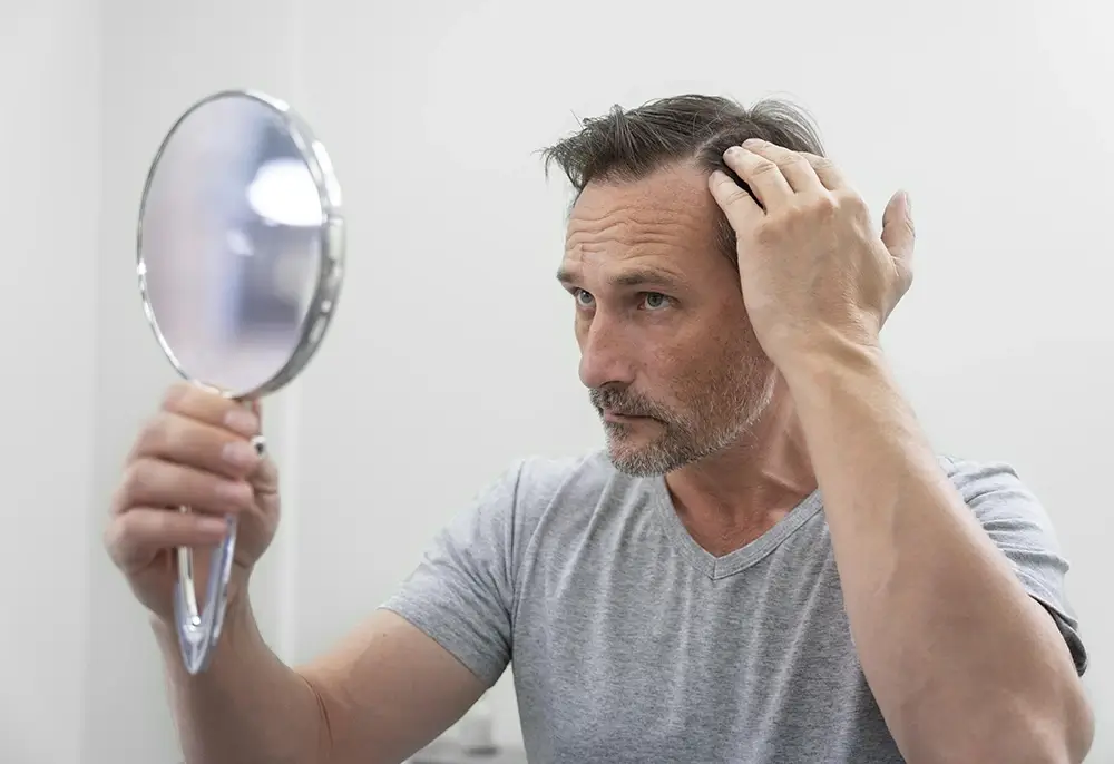 Los factores silenciosos que aceleran la calvicie en los colombianos imagen de la publicación