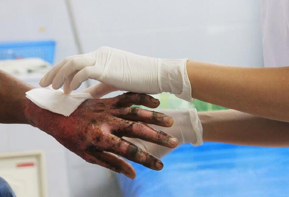 Preocupación tras aumento de quemados por pólvora en Santander: 18 personas entre ellas 7 menores imagen de la publicación