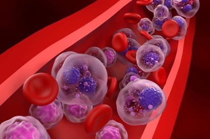Diagnóstico temprano del mieloma múltiple puede evitar daños irreversibles en pacientes imagen de la publicación