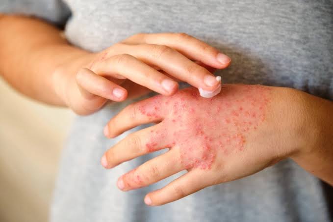 La dermatitis atópica afecta a uno de cada cinco niños en Colombia imagen de la publicación