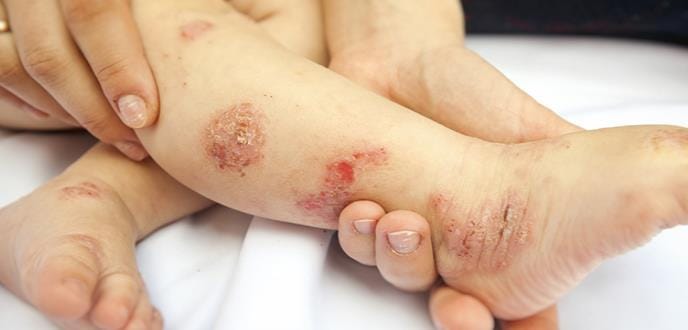 Dermatitis atópica en niños podría estar relacionada con otras enfermedades alérgicas imagen de la publicación