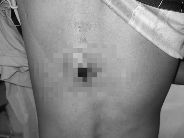 Le dispararon en la espalda por intentar evitar el robo de su moto en Barrancabermeja imagen de la publicación