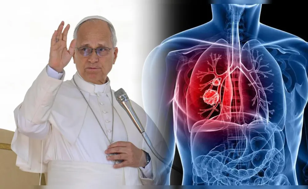 Qué es el adenocarcinoma pulmonar, el tumor maligno detectado al papa León XIV