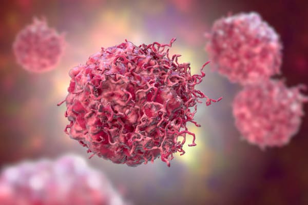 Sarcoma: La lucha contra el diagnóstico tardío en Colombia