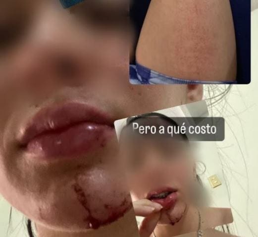Motoladrones la arrastraron por un bolso en Piedecuesta