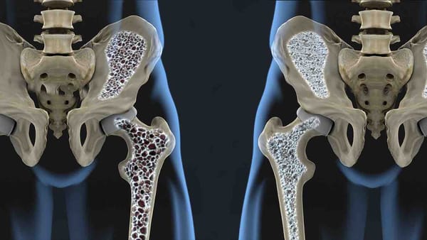 Premian al SES Hospital Universitario de Caldas por excepcional manejo de la osteoporosis