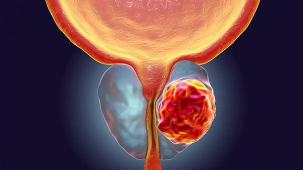 Detección temprana del cáncer de próstata