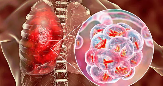 Alerta en Santander: 350 casos de tuberculosis en lo que va del año