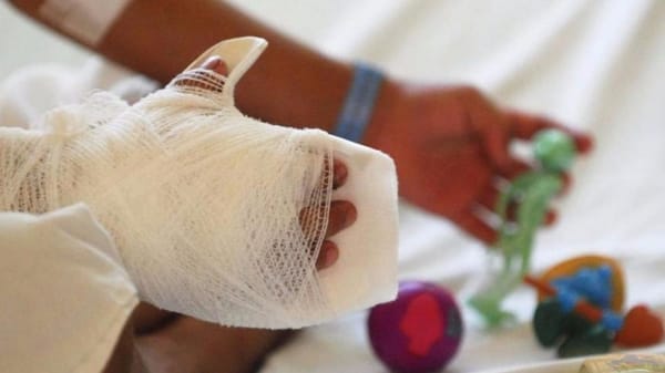 Lo que nadie cuenta sobre las quemaduras con pólvora